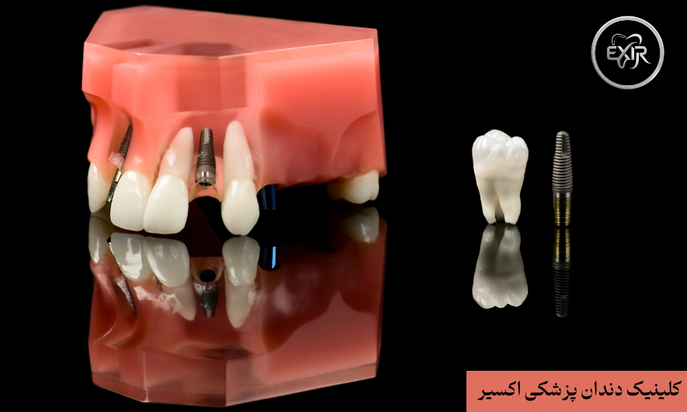 مراحل درمان ایمپلنت