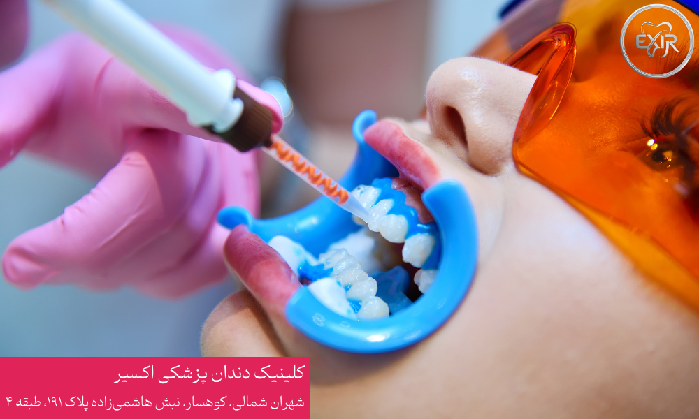 ایمنی و سلامت دندان در بلیچینگ