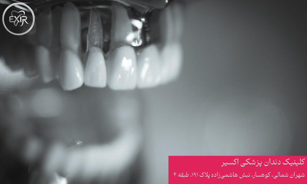کشیدن دندان بدون درد