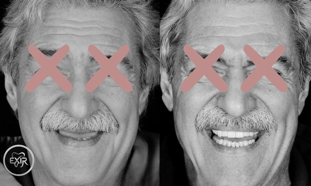 نمونه درمان ایمپلنت قبل و بعد - کلینیک اکسیر