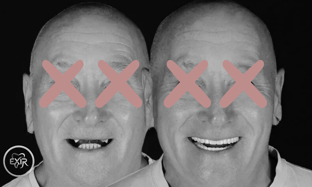 ایمپلنت ساب پریواستیل روی فک