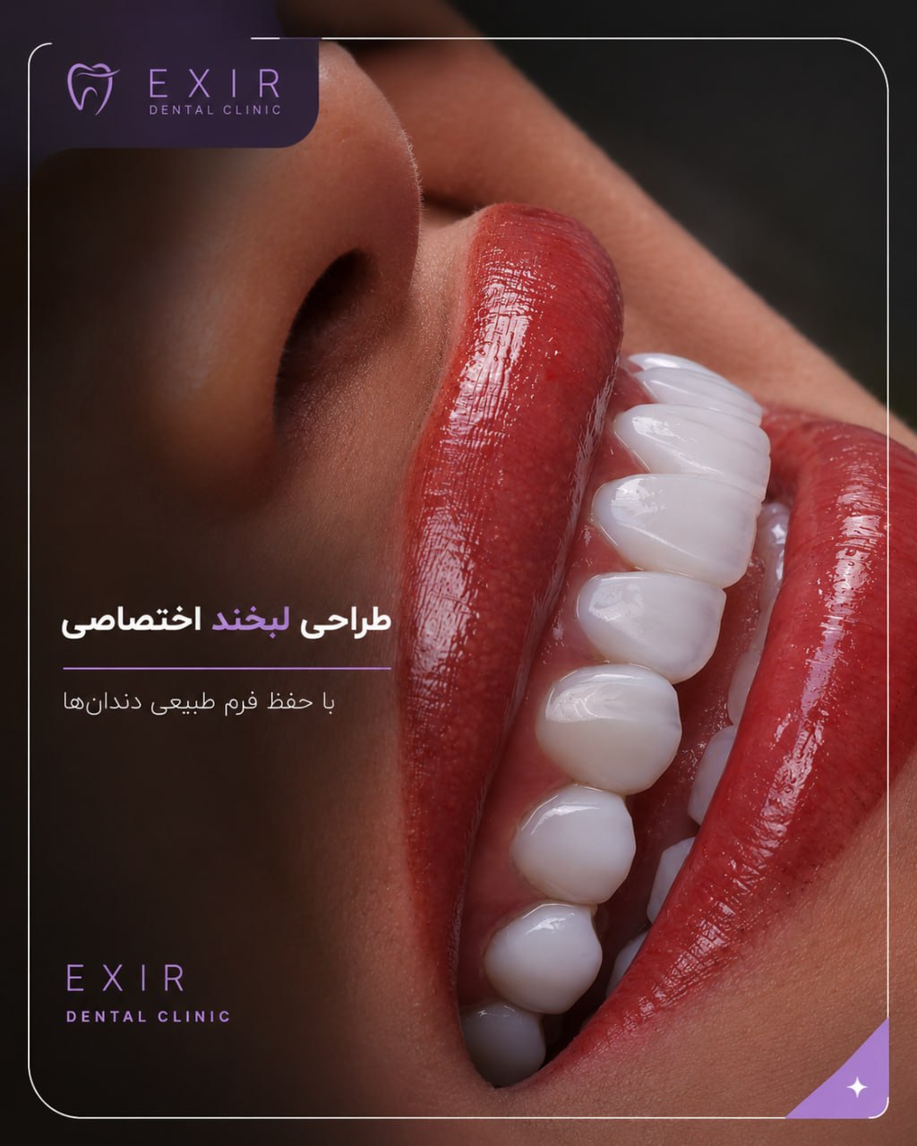 نمونه کار کامپوزیت واقعی در کلینیک اکسیر