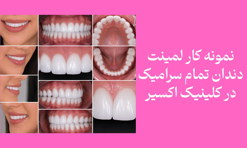 نمونه تصویری طراحی لبخند برای صفحه لمینت دندان اکسیر