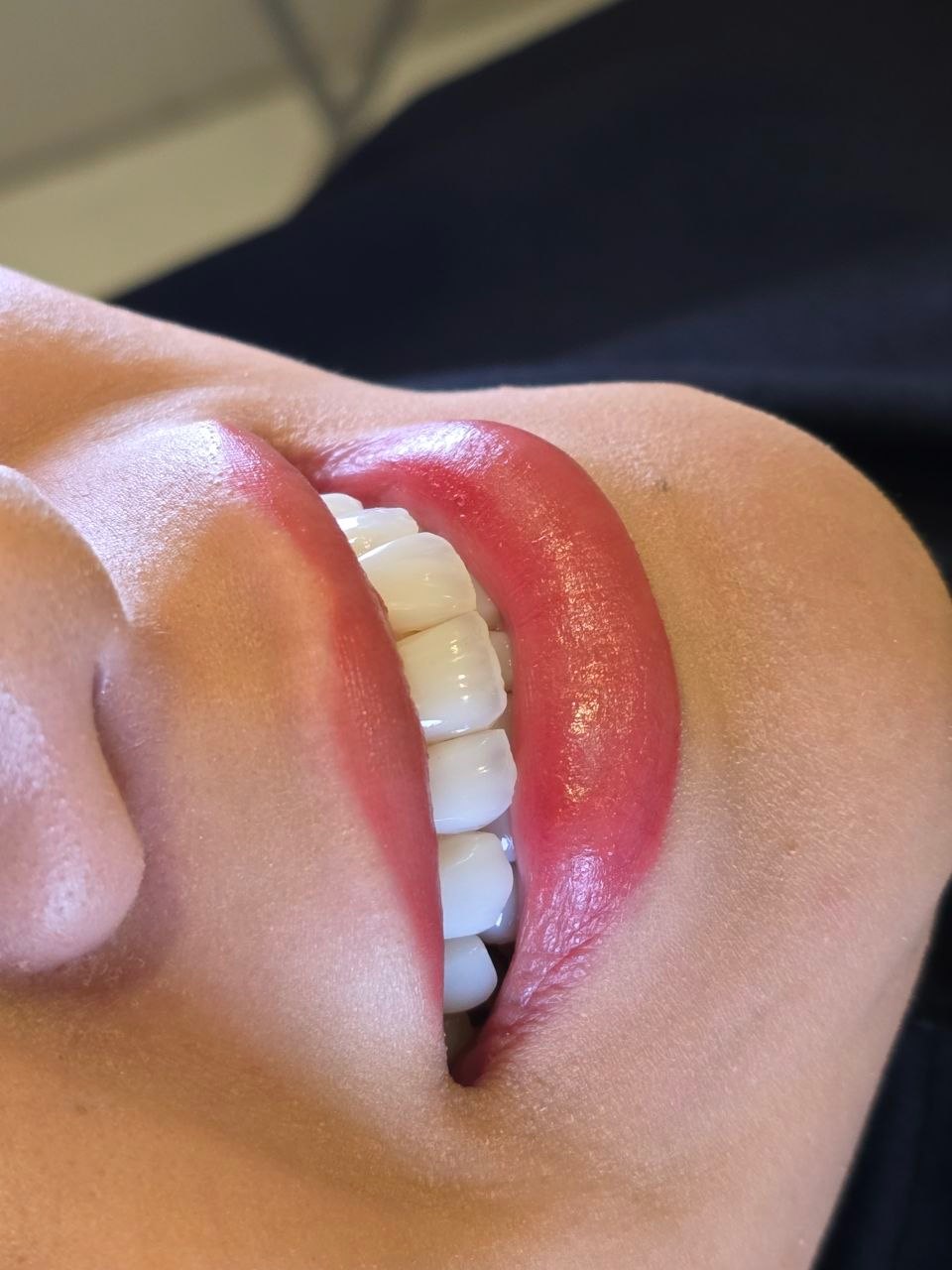 نمونه تصویری لبخند برای بررسی طراحی لمینت دندان