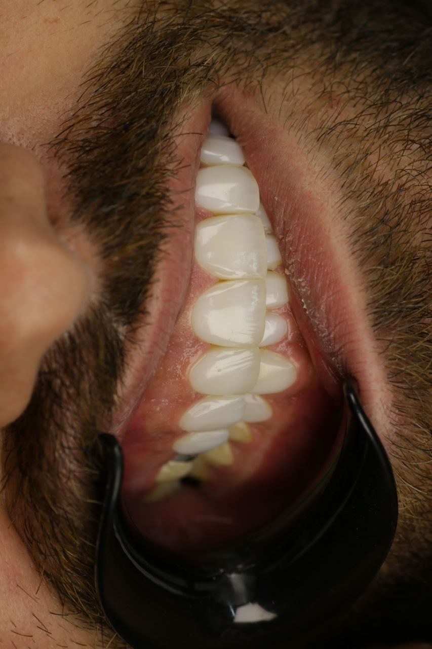 نمونه نتیجه کامپوزیت در کلینیک دندانپزشکی اکسیر