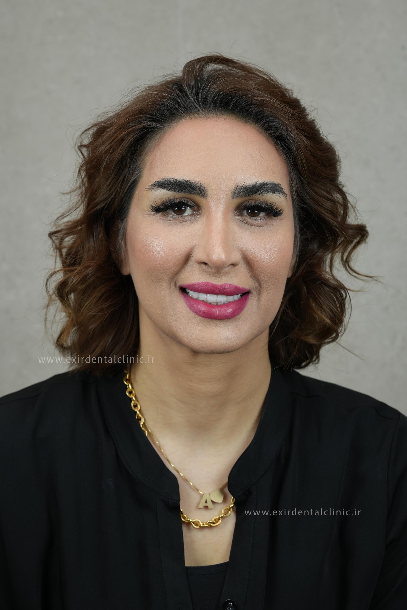 نمونه کامپوزیت دندان از گالری کلینیک اکسیر