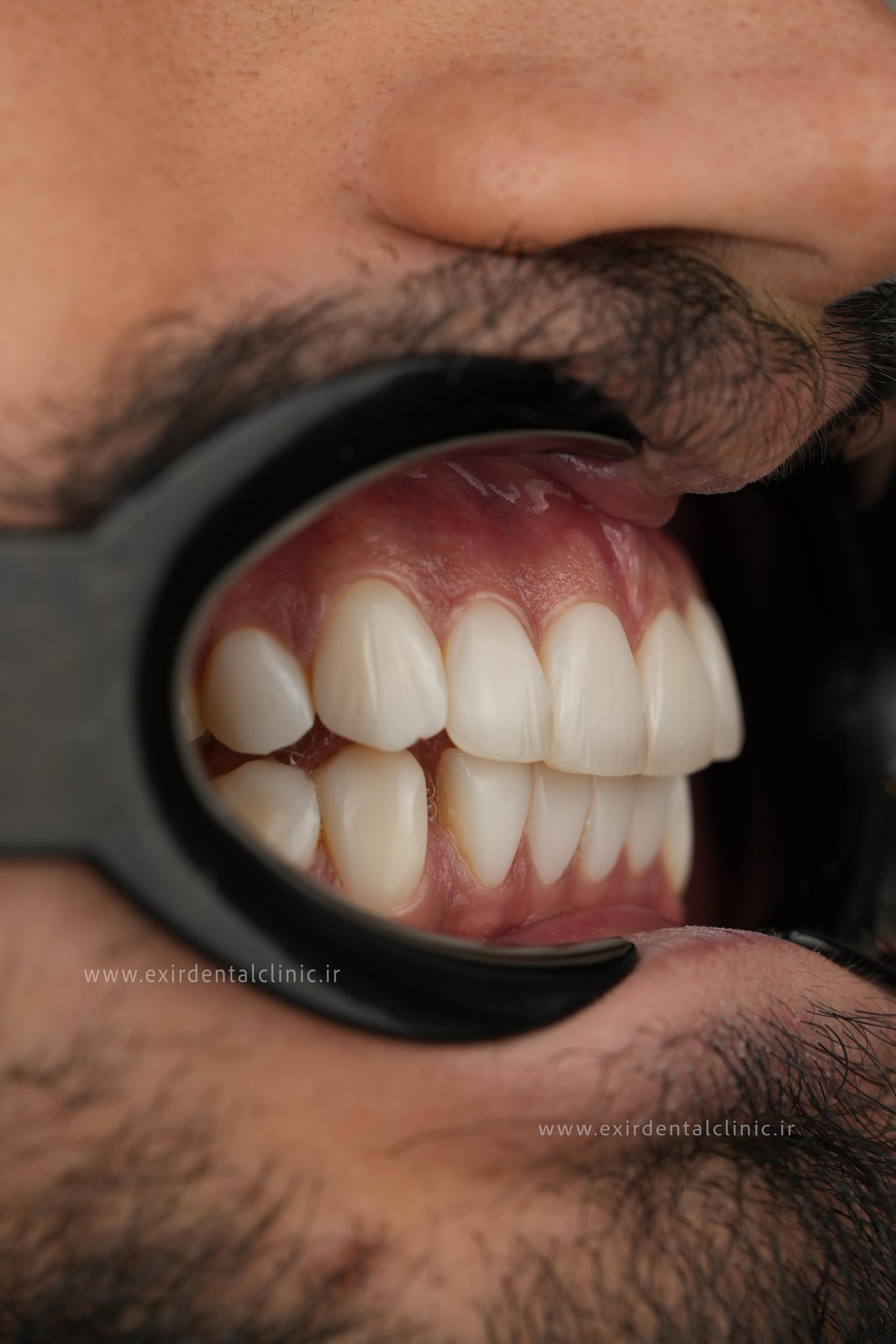تصویر جدید کامپوزیت از آرشیو کلینیک اکسیر